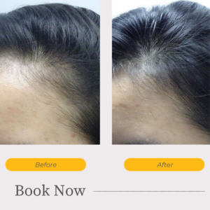 Early Receding Hairline – Why it can happen in young women 