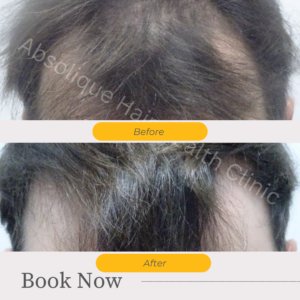 Male pattern baldness treatment – pre hair transplants