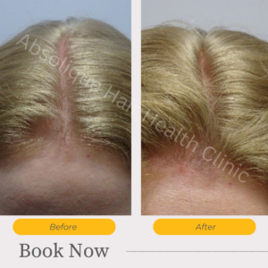 Hair fall cause – birth control hair loss