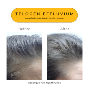 Cause of hair loss – why is my hair falling out