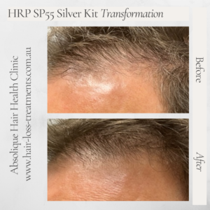 PRP Hair treatment alternative